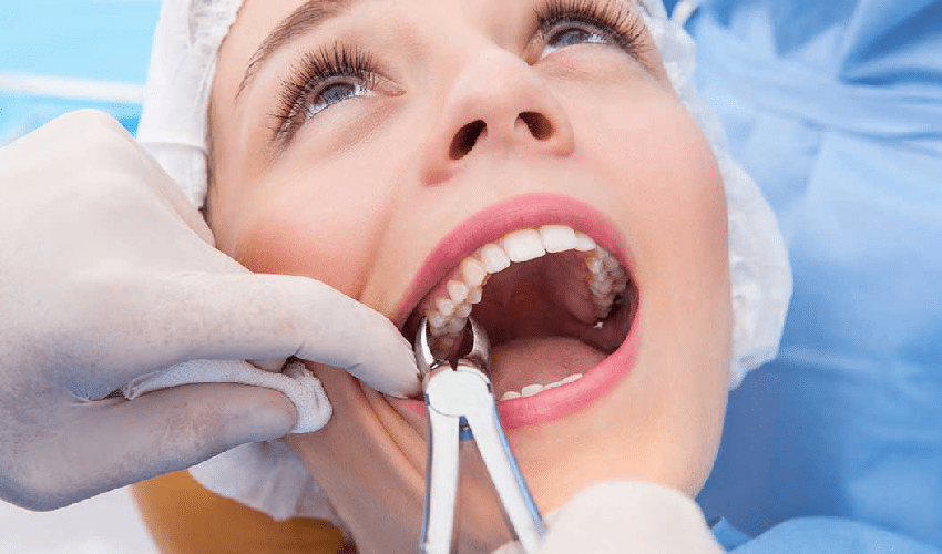 Tooth Extractions